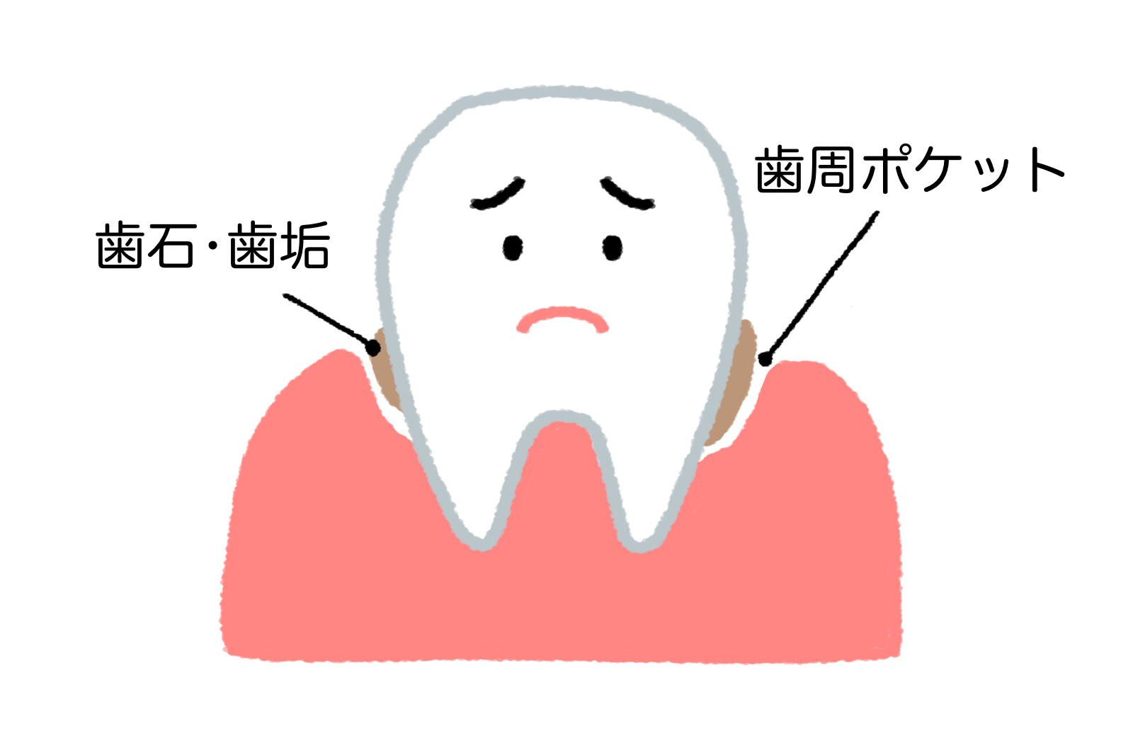 歯周病のイラスト