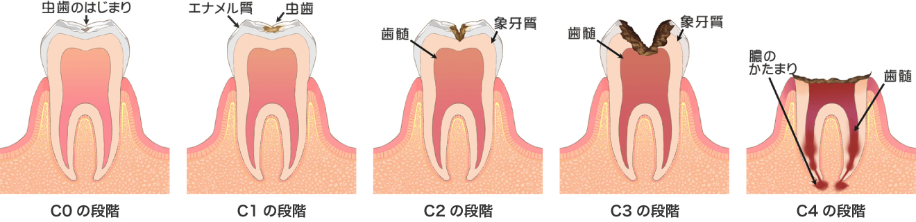 虫歯の段階