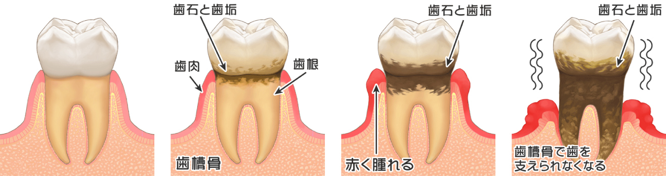 歯周病の段階