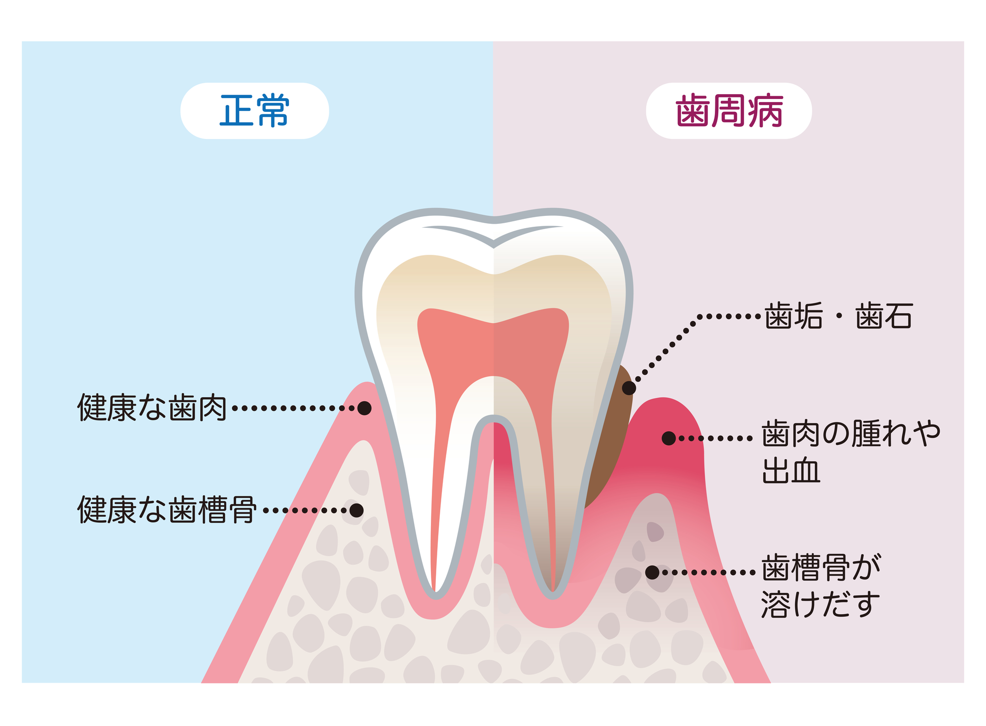 歯周病の治療