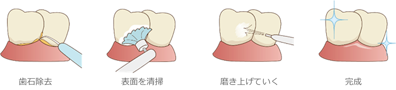 歯のクリーニング